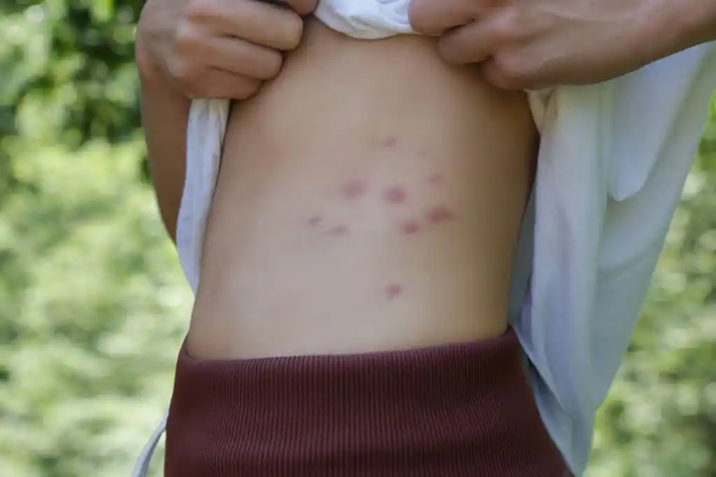 Person lifting their shirt to reveal multiple mosquito bites on their torso, highlighting the necessity of Mount Dora mosquito control to prevent such incidents.