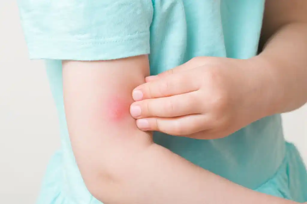 Child with a mosquito bite on their arm, highlighting the need for effective Winter Park mosquito control.